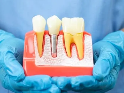 Dental Implants