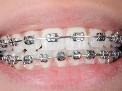 Teeth Alignment (Braces)